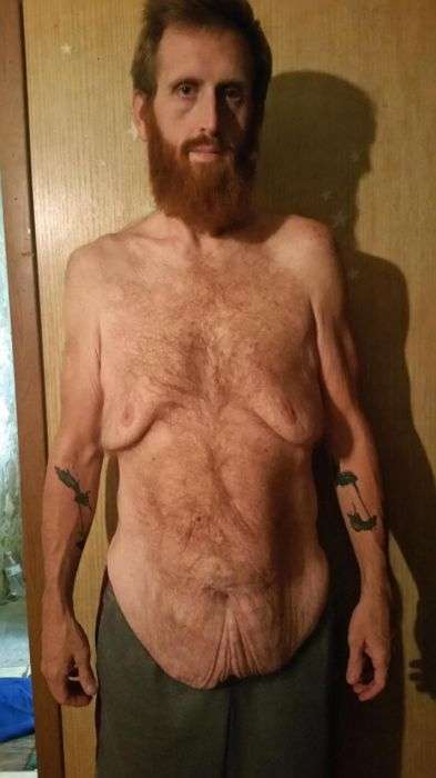Американець схуд на 160 кг, щоб не померти (10 фото)