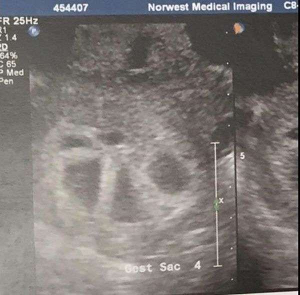 Так виглядає жінка, вагітна пятерняшками (6 фото)