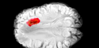 Старый препарат от давления показывает многообещающие результаты в борьбе со смертельно опасной формой рака мозга