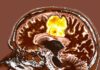 Simple Supplement Combination Shows Promise in Fighting Glioblastoma