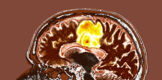 Simple Supplement Combination Shows Promise in Fighting Glioblastoma