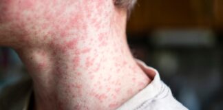 La ripresa del morbillo segnala una più ampia debolezza della sanità pubblica negli Stati Uniti