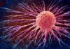 Fermare il cancro alla prostata sul nascere
